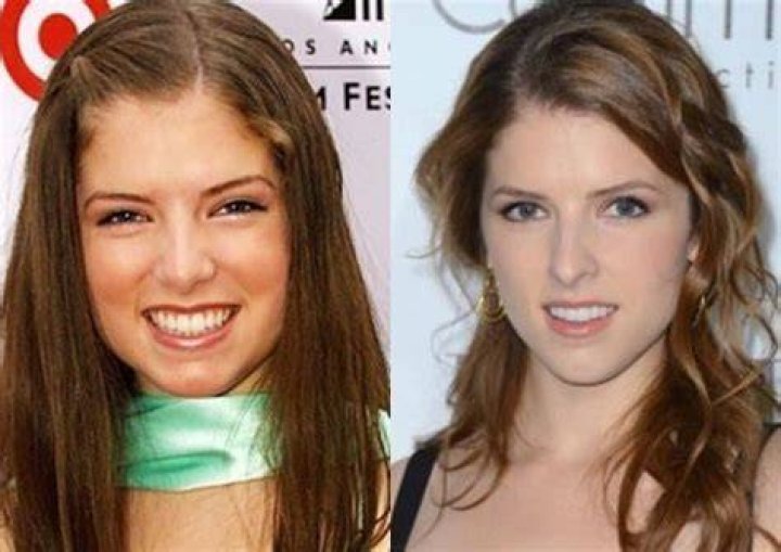 Anna Kendrick Plastic Surgery Before and After