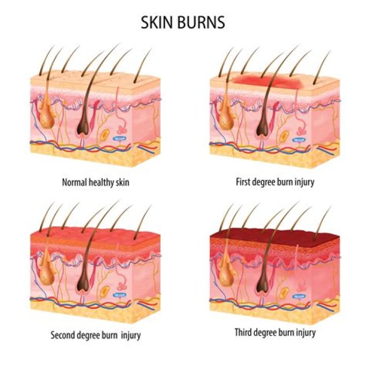 Burns