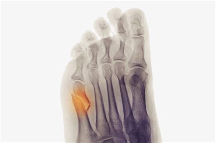 We Broke the Same Bone. My Recovery Was a Breeze, Hers an Ordeal. Why?
